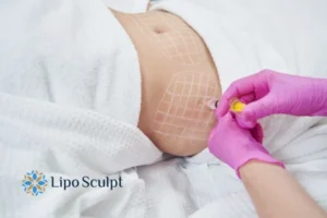 Are The Results From Aqualyx Permanent? 1 Do you want to know how long Aqualyx Frome results last?
